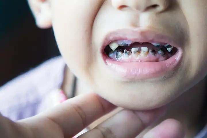 Tooth Decay in Children - Causes, Treatment & Prevention
