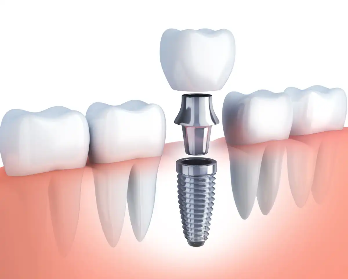 Dental Implants: What to Expect, Procedure & FAQs
