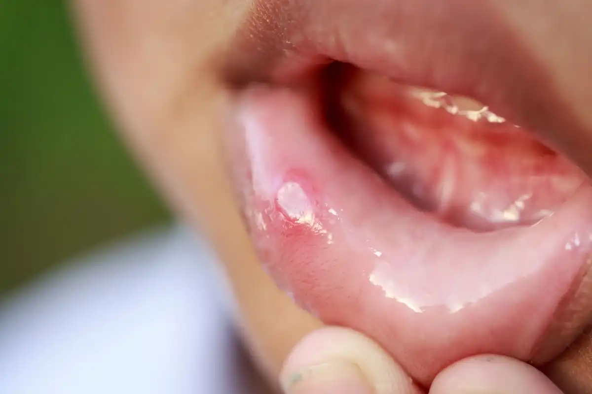 Can You Pop a Canker Sore? No, It Will Cause More Problems