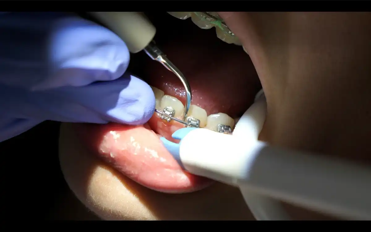Dental Cleaning Orthodontics Tips For Dental Hygienist