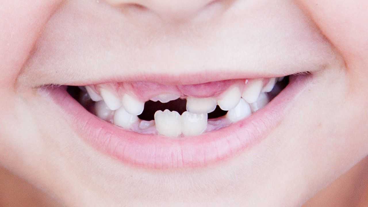 Mamelon Teeth | What Are They & How To Remove Them