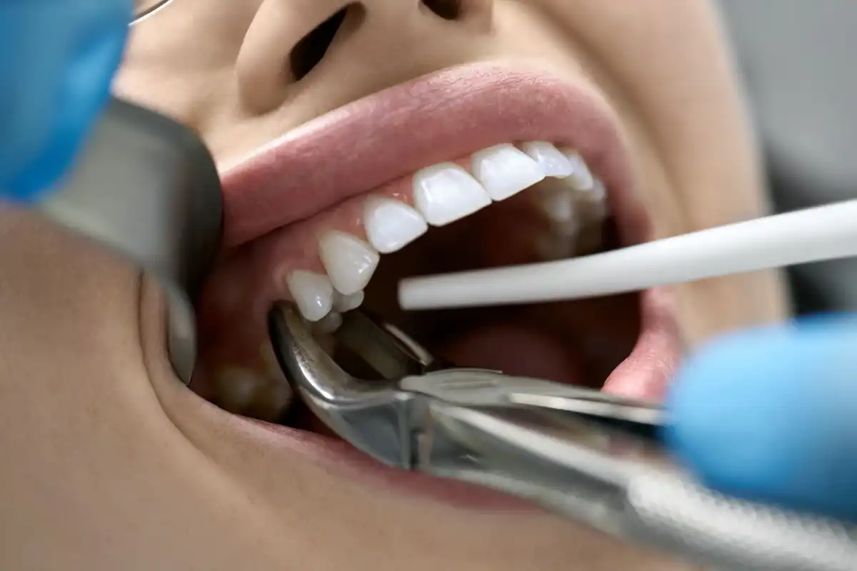 Root Canal vs. Extraction: Which is the BEST Option?