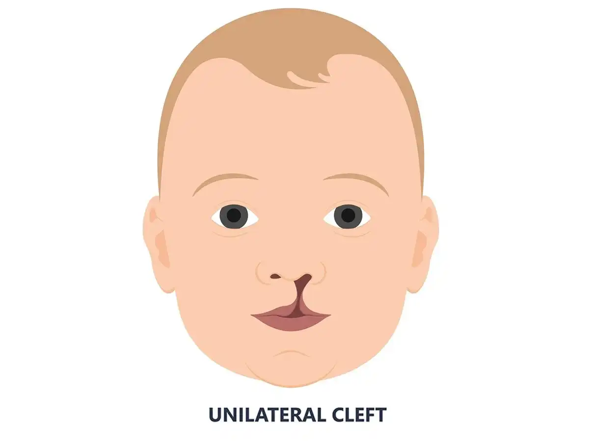 Cleft Lip