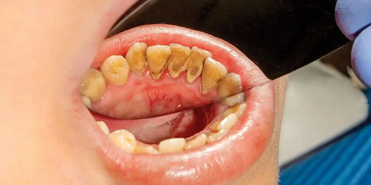 Does tartar Removal Damage Teeth?