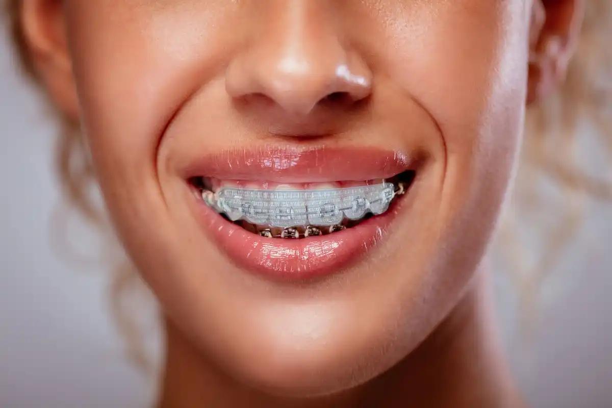 Can You Whiten Your Teeth While Wearing Braces?
