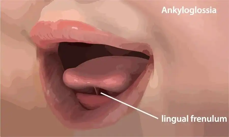 Tongue-tie in Babies: A Guide for Parents
