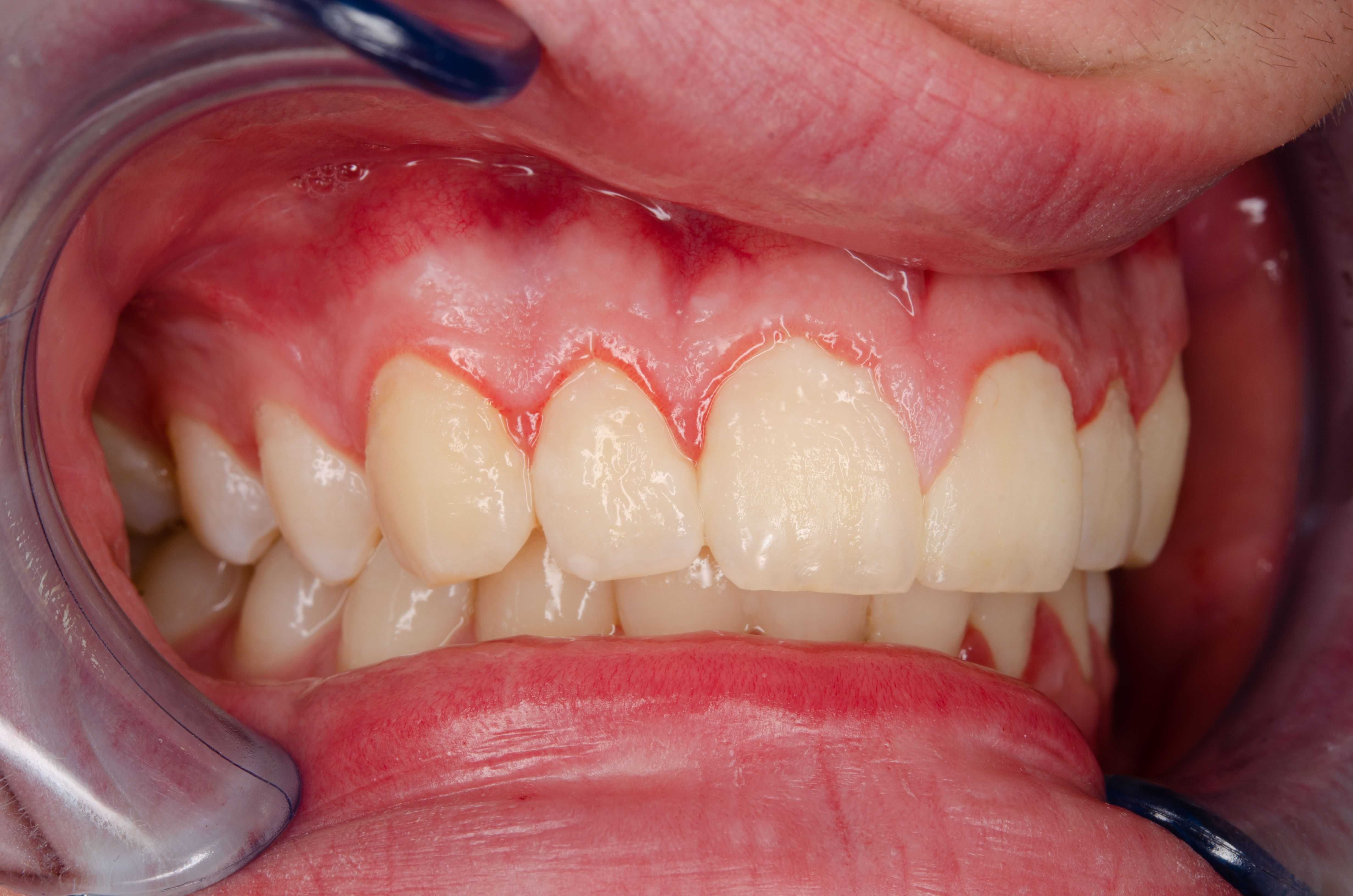 Tartar on Teeth (Dental Calculus): Causes & Removal